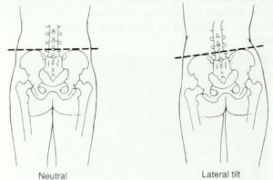 lateral-pelvic-tilt